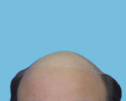 Hair Loss Before Picture