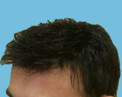 Hair Loss Treatment in Queens, NY