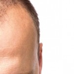 Common Causes of Hair Loss in Men