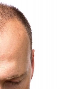 Common Causes of Hair Loss in Men