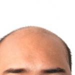 Understanding Androgenic Alopecia