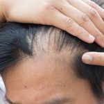 Hair Loss Overview