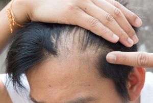 Hair Loss Overview