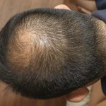 Hair Loss Worries