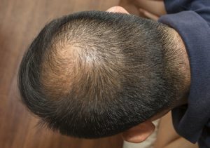 Hair Loss Worries