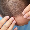 Here’s Why You Shouldn’t Wait to Go to a Hair Loss Specialist