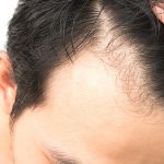 Male Hair Loss