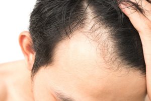 Male Hair Loss