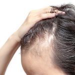 Hair Loss as a Disease